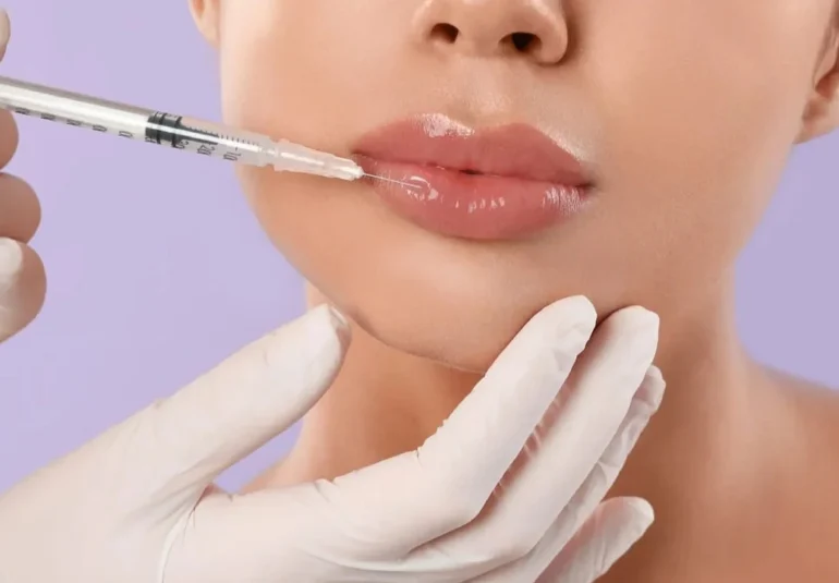 Lip Fillers